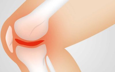 Stem Cell Knee Injections After an ACL Injury