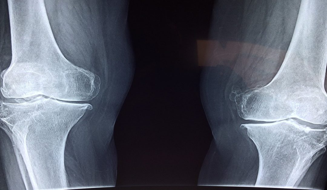 stem cell therapy for knees Stem Cell Miami