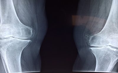 Common Misconceptions About Stem Cell Therapy for Knees