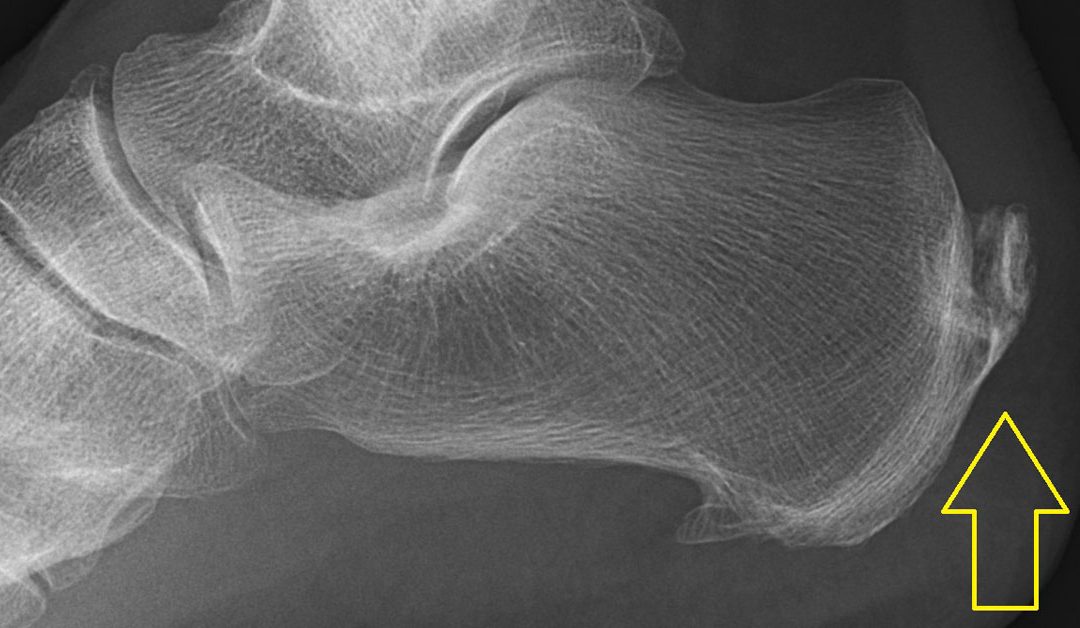 tendinitis treatment miami