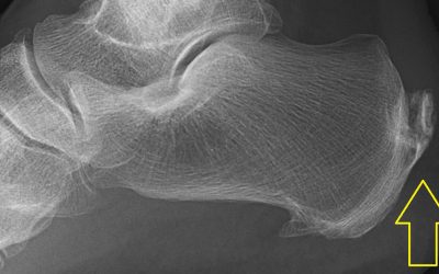 Find Tendinitis Relief Today with the Help of PRP Treatments