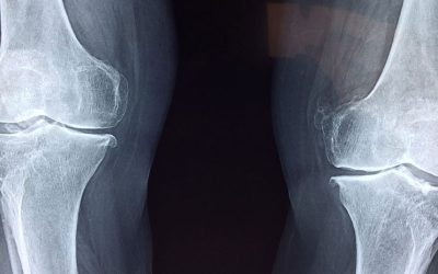 Orthopedic Intervention for A Healthier You