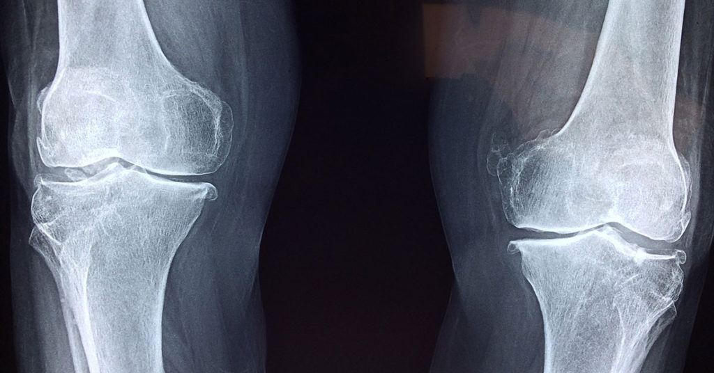 osteoarthritis in miami 1024x536 1