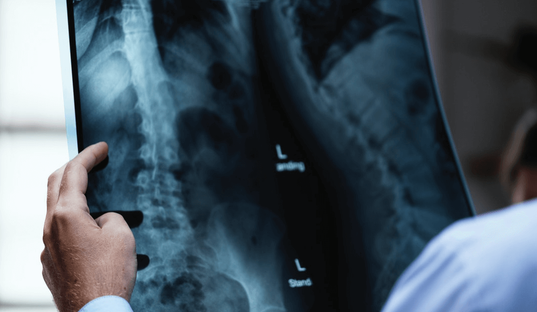 stem cell therapy for ankylosing spondylitis in Miami