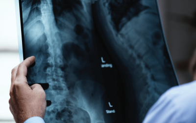 Studies Show Stem Cells Are Helping Those With Spondylosis