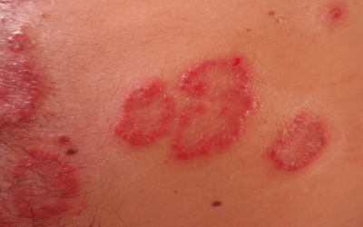 PRP For Shingles? This Treatment May be Available In the Near Future