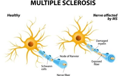 Stem Cell Therapy for Patients With MS – A Randomized Study