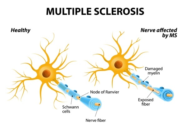 Stem Cell Therapy for Patients With MS – A Randomized Study