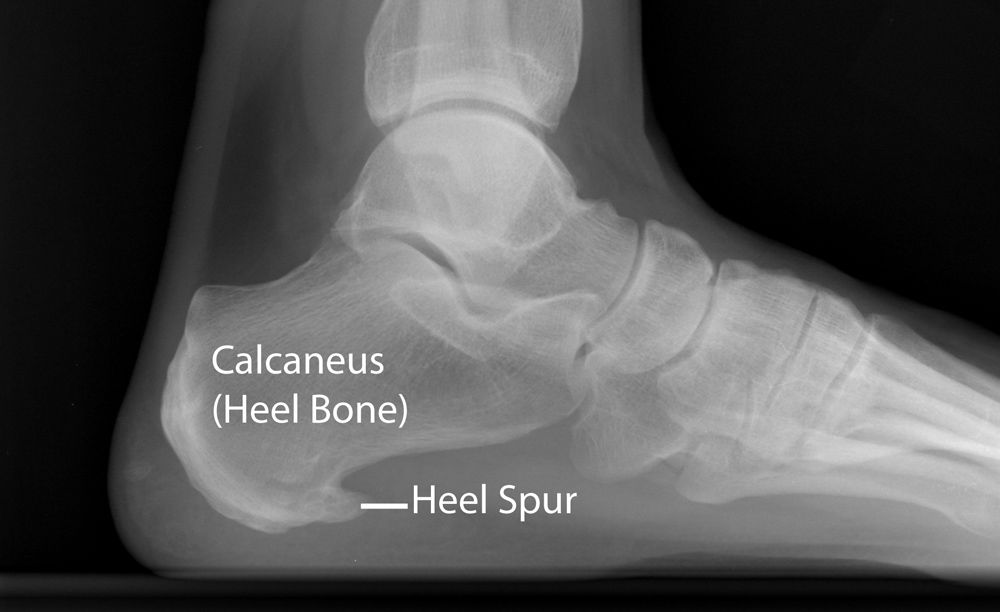 What is a Calcaneus Spur?