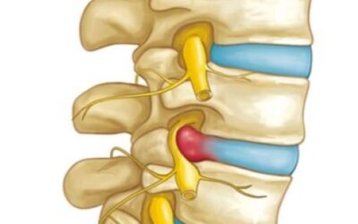 What is a herniated disc?