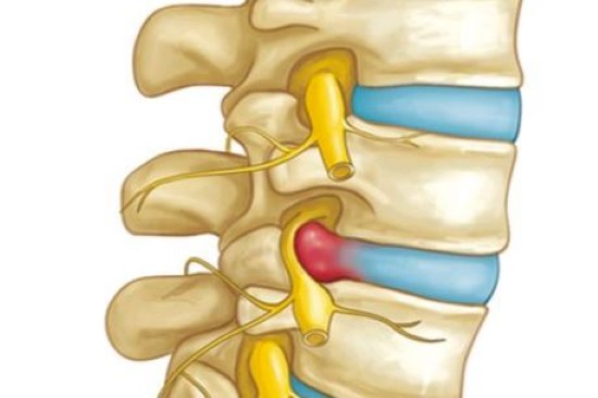 What is a herniated disc?