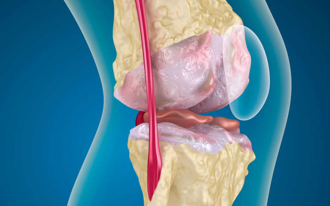 Bone Marrow Aspirate Concentrate for the Treatment of Knee Osteoarthritis: A Systematic Review