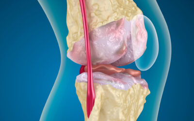Bone Marrow Aspirate Concentrate for the Treatment of Knee Osteoarthritis: A Systematic Review