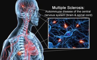 Reports of Multiple Sclerosis Remission After Stem Cell Transplant!