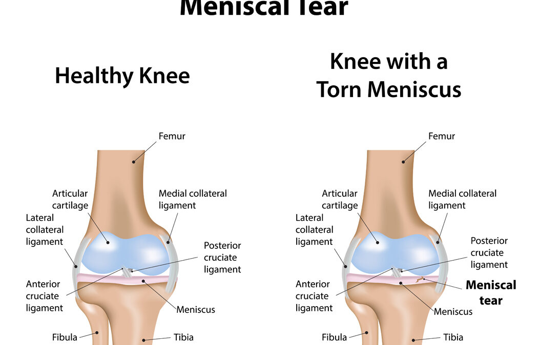 The Meniscus Tear: A Review of Stem Cell Therapies