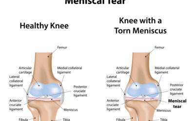 The Meniscus Tear: A Review of Stem Cell Therapies