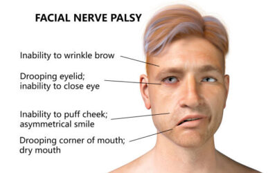 Case Report: Bell’s Palsy and Stem Cell Therapy