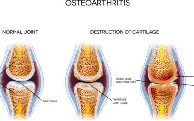 Mesenchymal stem cells in osteoarthritis therapy: a review