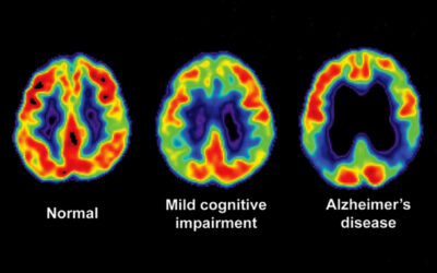 Stem cell therapy for Alzheimer’s disease