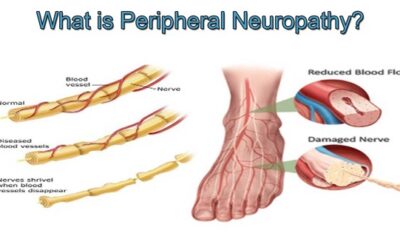 Concise Review: Stem Cell Therapies for Neuropathic Pain