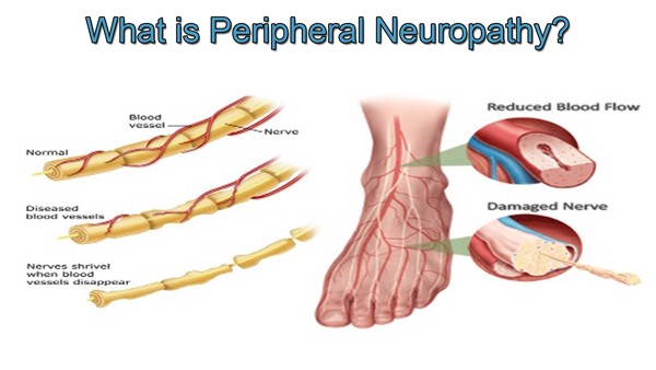 Concise Review: Stem Cell Therapies for Neuropathic Pain