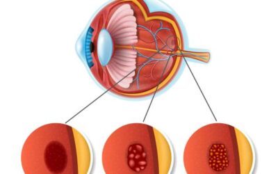 RESTORING LOST VISION New Stem Cell Treatment Developed for AMD
