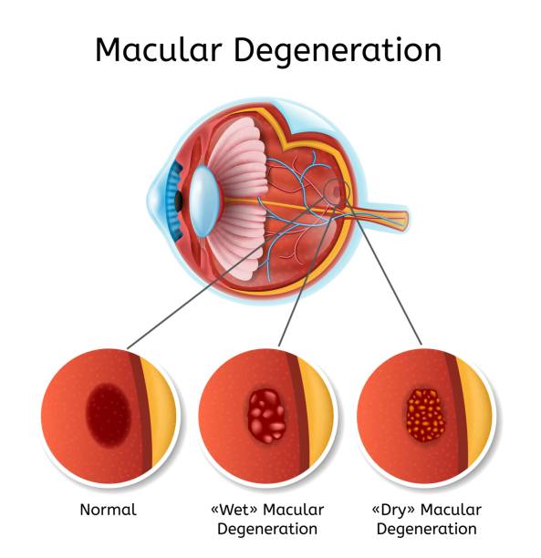 RESTORING LOST VISION  New Stem Cell Treatment Developed for AMD