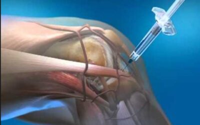 Clinical Update: Why PRP Should Be Your First Choice for Injection Therapy in Treating Osteoarthritis of the Knee