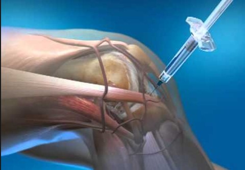 Clinical Update: Why PRP Should Be Your First Choice for Injection Therapy in Treating Osteoarthritis of the Knee