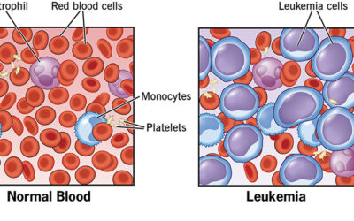 Leukemia Stem Cell Transplant