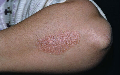 Clinical Research on Treatment of Psoriasis by Human Umbilical Cord-derived Mesenchymal Stem Cells
