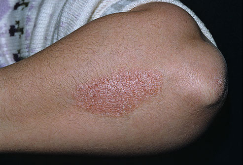 Clinical Research on Treatment of Psoriasis by Human Umbilical Cord-derived Mesenchymal Stem Cells