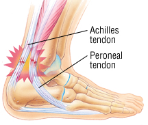 Platelet-rich plasma injections for the treatment of refractory Achilles tendinopathy: results at 4 years