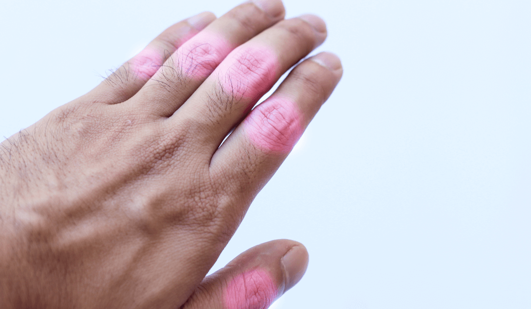 Stem Cell Therapy for Arthritis: A Revolutionary Treatment Option