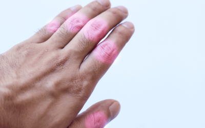 Stem Cell Therapy for Arthritis: A Revolutionary Treatment Option